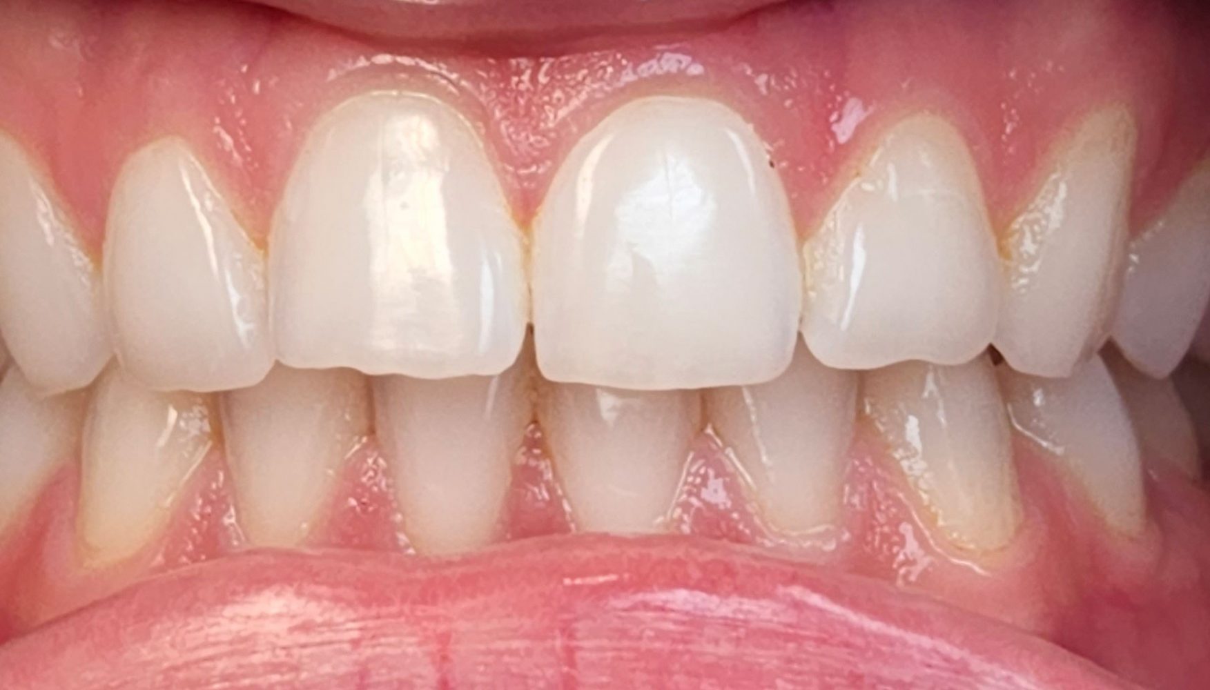 Patient 1, before dental treatment