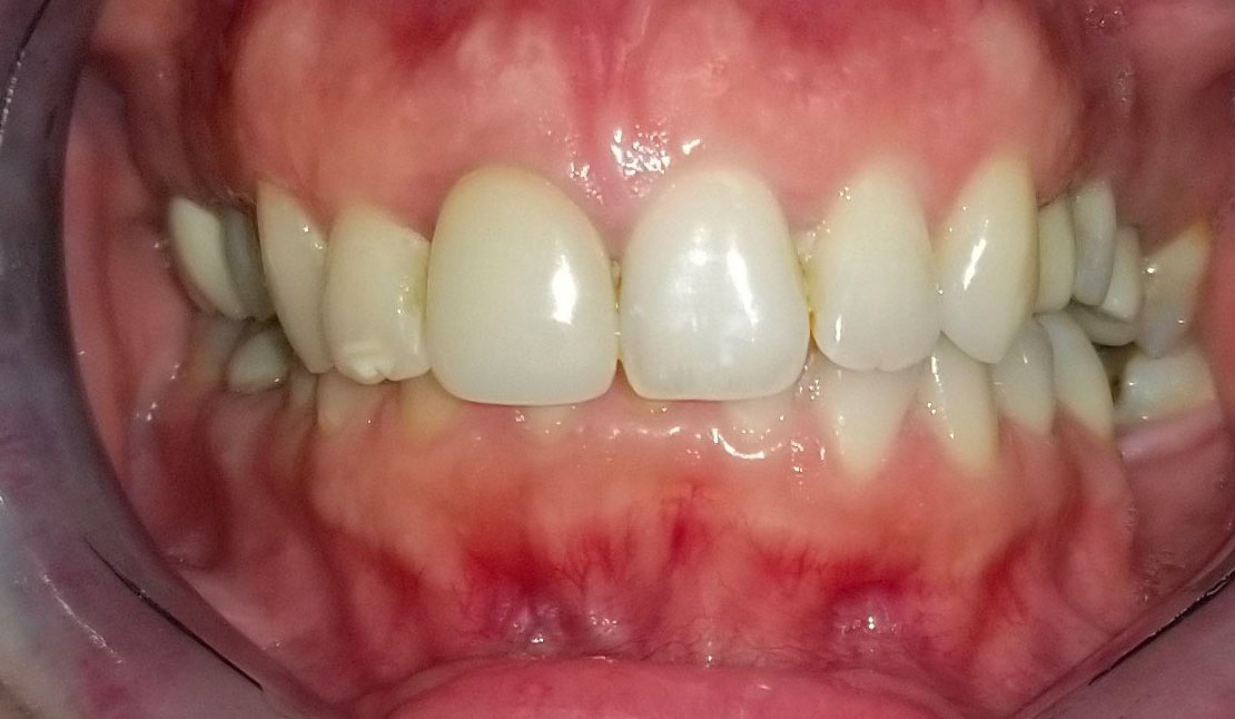 Patient 2, before dental treatment
