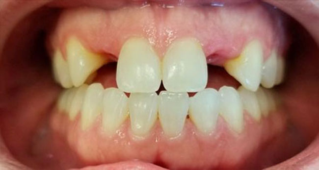 Patient 4, before dental treatment